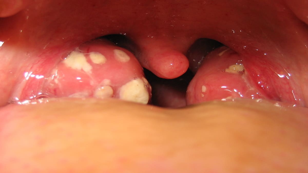 sop tonsillitis