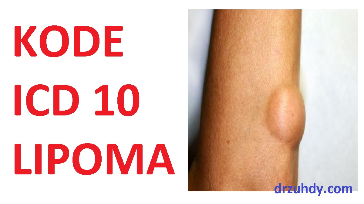 Daftar Kode Diagnosa Penyakit Lipoma Menurut ICD 10