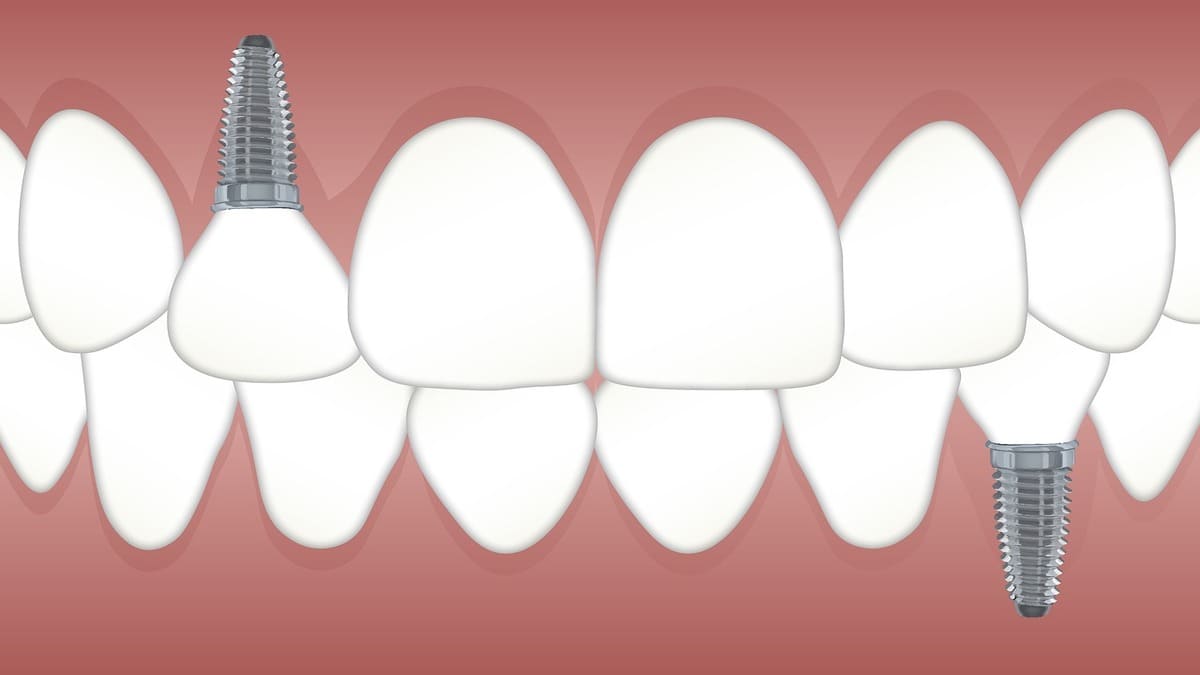bagaimana cara menghilangkan sakit gigi dengan cepat alamiah
